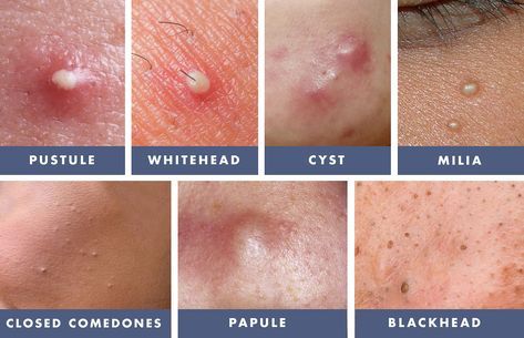 Updated 2/1/18. Skin Fact: All types of acne and blemishes are not equal. You must learn the differences between whiteheads, blackheads, pustules, papules, milia, closed comedones and cysts, and treat them accordingly to make them go away fast with the … Continued Different Types Of Acne, Blackhead Remedies, Diy Dry Shampoo, Skin Facts, Skin Care Routine For 20s, Types Of Acne, Routine Skincare, Acne Remedies, Acne Skin