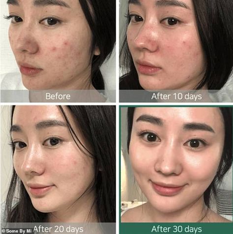 The Korean 'miracle' toner that has sold over 1.2 million units - and it gets rid of acne in 30 days | Daily Mail Online Miracle Toner, Some By Mi, Skin Care Routine For 20s, Aha Bha, Korean Skincare Routine, Skin Toner, How To Get Rid Of Acne, Skin Routine, Glass Skin