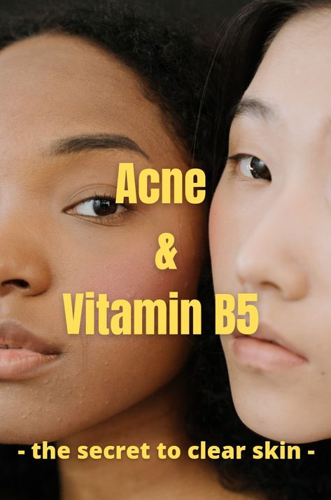 Vitamin For Acne Clear Skin, Best Vitamins For Acne, Vitamins For Hormonal Acne, Vitamins For Acne Clear Skin, Face Acne Remedies, Supplements For Acne, Nodule Acne, Best Acne Scar Removal, Cystic Acne Remedies