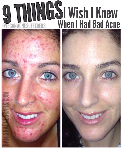 9 Things I Wish I Knew When I Had Bad Acne - Banish Girl With Acne, Face Breaking Out, Cystic Acne Remedies, Blind Pimple, Teenage Acne, Pimples Under The Skin, Forehead Acne, Acne Products, Acne Overnight