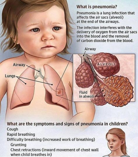 Pneumonia In Children, What Is Pneumonia, Signs Of Pneumonia, Pneumonia In Kids, Pneumonia Symptoms, Streptococcus Pneumoniae, Kids Cough, Lung Infection, Carbon Dioxide