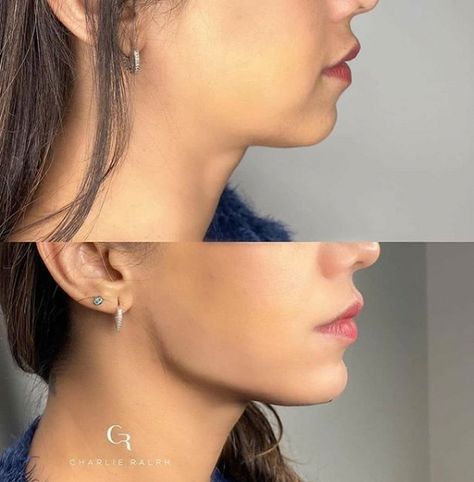 Jawline Filler, Jaw Reduction Surgery, Face Plastic Surgery, Chin Filler, Chin Implant, Face Fillers, Face Surgery, Jaw Surgery, Cheek Fillers