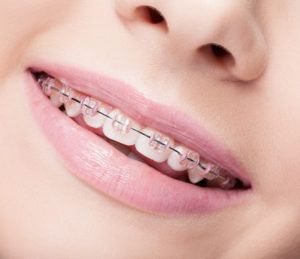 Taking care of your braces at school might be a touch more difficult than at home. Check out these tips so you can always know how to maintain your braces! Ceramic Braces, Traditional Braces, Teeth Straightening, Hygiene Care, Healthy Smile, Oral Hygiene, Braces, Beautiful Smile, How To Fall Asleep