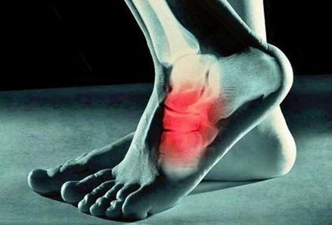 Cuboid Syndrome, Ankle Replacement, Dallas Neighborhoods, Ankle Sprain, Calf Cramps, Ankle Surgery, Types Of Surgery, Bone Structure, Plano Texas