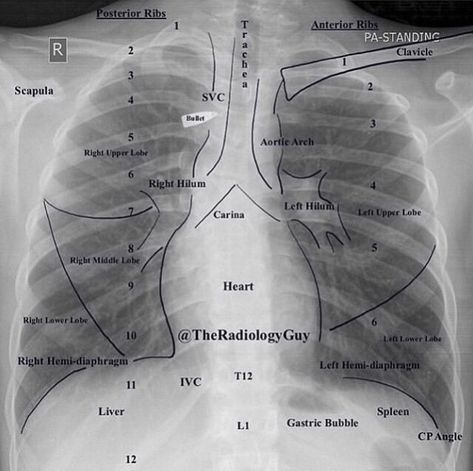 Chest Xray, Radiology Schools, Medical Radiography, Radiology Student, Radiology Imaging, Medicine Notes, Medical Student Study, Respiratory Therapy, Medical School Studying