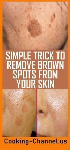 Simple Trick To Remove Brown Spots From Your Skin Brown Age Spots, Age Spot Removal, Brown Spots On Skin, Home Remedies For Skin, Brown Spots Removal, Brown Spots On Face, Skin Spots, Spots On Face, Health Tips For Women