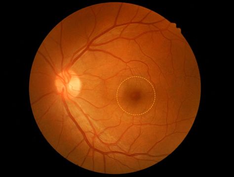 What Is a Macular Hole? Macular Hole, Focus Images, Dense Fog, Nerve Cell, Make A Person, Eye Health, Eye Care, Dark Spots, Handles