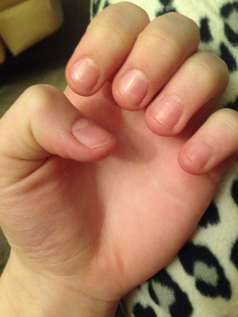 Day 1, the day I decided to stop biting my nails Bitten Nails, Nail Growth Faster, Nail Growth Tips, Food Nails, Nail Quotes, Nail Care Routine, Casual Nails, How To Grow Nails, Nutritious Diet