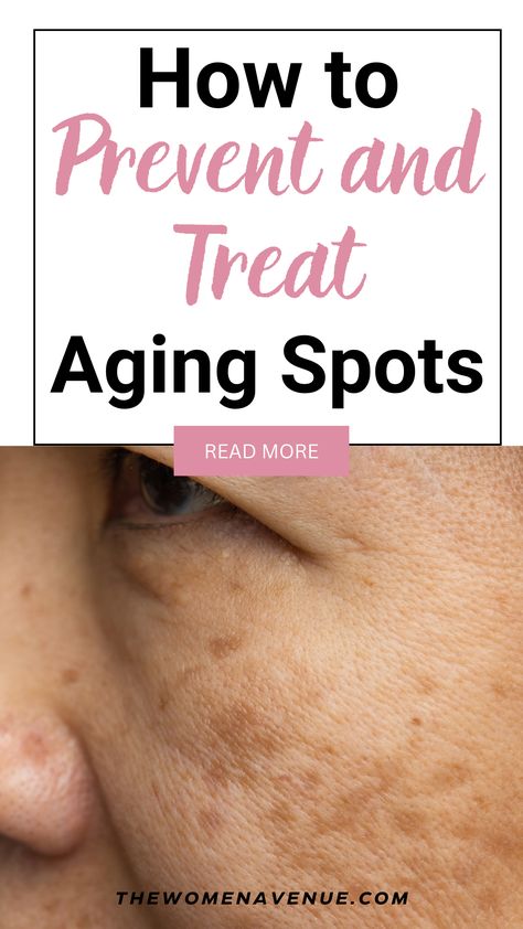 Are you suffering from aging spots on your face? Are you looking for ways to prevent more aging spots to appear? In this post I am sharing with you the BEST and natural ways you can treat them! Did you know that you can fade dark spots within a few weeks only?! Click Here to read how! How To Close Pores, Age Spots On Face, Age Spot Removal, Dry Oily Skin, Dark Spots On Face, Lower Back Pain Exercises, Skin Tags, Spots On Face, Anti Aging Beauty