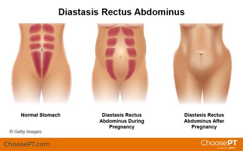 What Is Diastasis Recti, Rectus Abdominis Muscle, Rectus Abdominis, Pregnancy Pain, Stability Exercises, Stomach Muscles, Pelvic Floor Muscles, Diastasis Recti, Physical Therapist