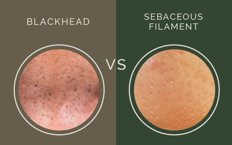 blackhead versus sebaceous filament, what's the difference? congestion / clogged pores / Clogged Pores On Nose, Blackheads On Cheeks, What Are Blackheads, Pores On Face, Sebaceous Filaments, Nose Pores, Blackheads On Nose, Rid Of Blackheads, Acne Overnight