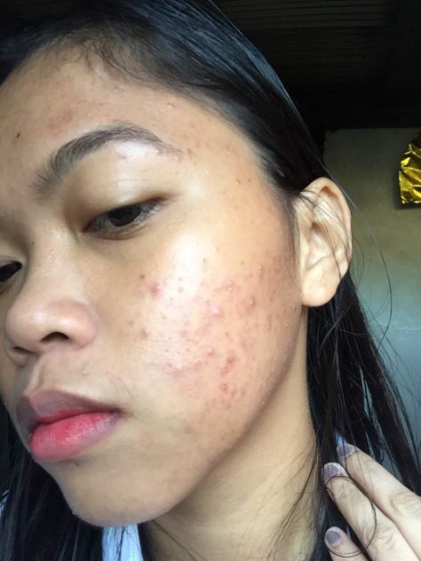 Acne Journey, Acne