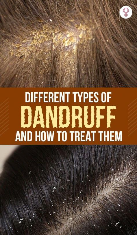 There are different types of dandruff. To effectively treat it and prevent future flakes, we Long Hai, Oils For Dandruff, Dandruff Remedy, Getting Rid Of Dandruff, How To Grow Your Hair Faster, Natural Acne Remedies, Baking Soda Shampoo, Flexible Dieting, Hair Control