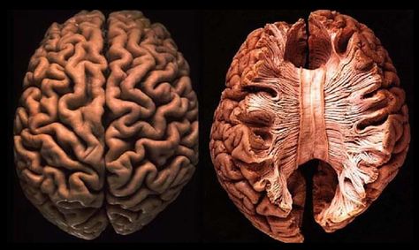 Dissected Brain Corpus Callosum Corpus Callosum, Best Tapas, Anatomy Study, Weird Dreams, Medical Illustration, Human Brain, Anatomy Reference, Mad Scientist, Anatomy Art