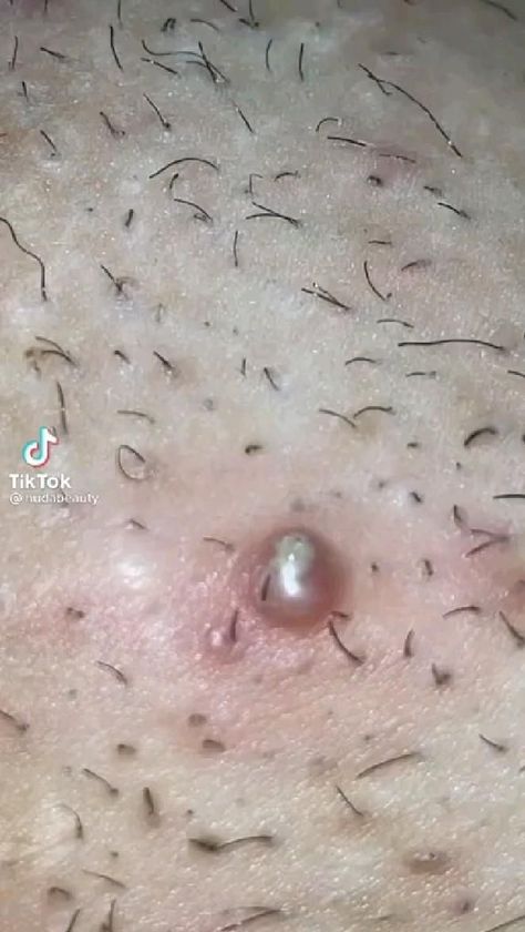 Pimple Poppìng Videos, Pimple Poppìng, Pimple Extractor, Blackhead Extraction, Blackhead Remedies, Face Care Tips, Anti Redness, Amazing Facts For Students, Clear Pores