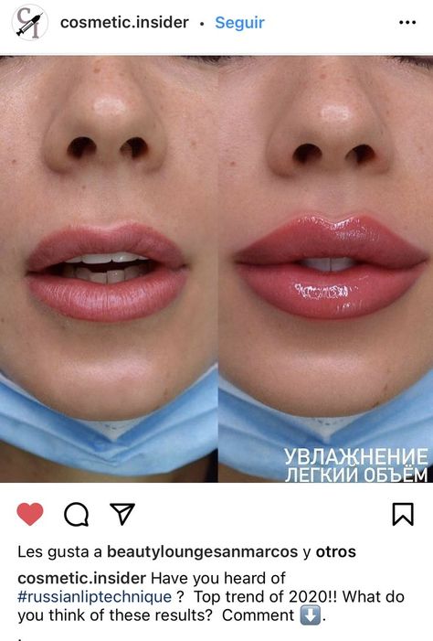 Lip Fillers Before And After 1ml, Russian Lips Filler, Aesthetics Practitioner, Saggy Cheeks, Botox Quotes, Dermal Fillers Lips, Botox Brow Lift, Day Eye Makeup, Heart Shaped Lips