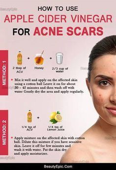 how to use apple cider vinegar for acne scars #diyacnetreatment Apple Cider Vinegar For Acne, Scar Remedies, Diy Facials, Face Diy, Minimalism Challenge, Bad Acne, Acne Scar Removal, Acne Remedies, How To Get Rid Of Acne