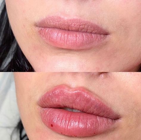 Lip Fillers Juvederm, Dermal Fillers Lips, Russian Lips, Nose Fillers, Lips Inspiration, Face Fillers, Botox Lips, Facial Fillers, Facial Contouring