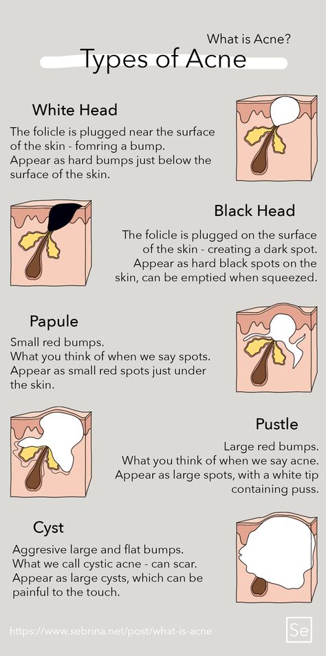 Head Acne, Blind Pimple, Pimples Under The Skin, Oily Skin Acne, Acne Overnight, Bad Acne, Pimples On Face, Tips For Oily Skin, Natural Acne Remedies