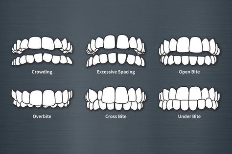 Crooked, chipped, or misaligned teeth are usually found in children and in adults. At the point when the teeth eject and grow they may overlap, twist or rotate to become crowded, crooked, or misaligned. Read this interesting blog for more details. https://royalimplant.com/blogs/fix-crooked-teeth-in-adult/ Fix Teeth, Misaligned Teeth, Crooked Teeth, The Teeth, Dental Clinic, One Day, Twist, Science, Reading