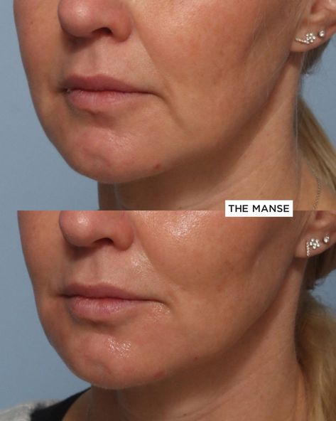 Face Fillers Before And After, Marionette Lines Filler, Face Injections, Face Procedures, Mouth Wrinkles, Botox Before And After, Face Treatments, Face Fillers, Marionette Lines