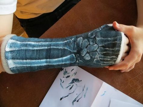 X-Ray Painted Cast Arm Cast Aesthetic, Cast Drawing Ideas Arm, Broken Arm Cast, Cast Decoration, Cast Drawing, Plaster Hands, Arm Cast, Cast Covers, Cast Art