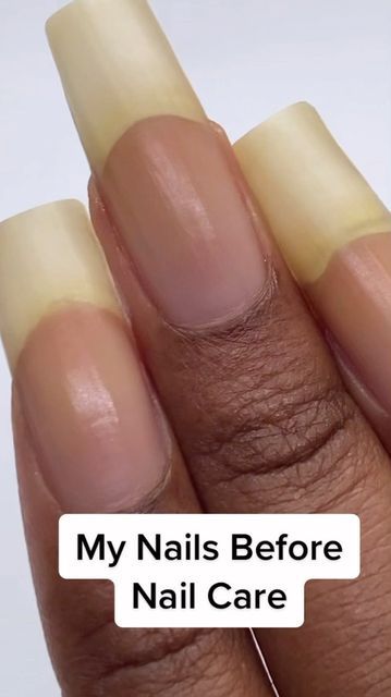 Nail Growth Tips, Grow Nails Faster, Nail Serum, Nail Care Tips, How To Grow Nails, Brittle Nails, Nail Oil, Ingrown Toe Nail, Striped Nails