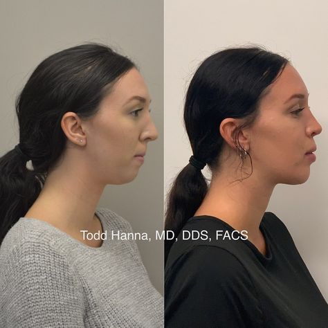 Dr. Todd Hanna, MD, DDS, FACS on Instagram: “This is a complex case with 2 main problems.. 1. She was treated with a chin implant elsewhere when she really needed orthognathic surgery…” Chin Implant Before And After Women, Orthognathic Surgery Before And After, Chin Implant Before And After, Surgery Motivation, Fix Overbite, Double Chin Surgery, Chin Surgery, Jaw Reduction Surgery, Double Jaw Surgery