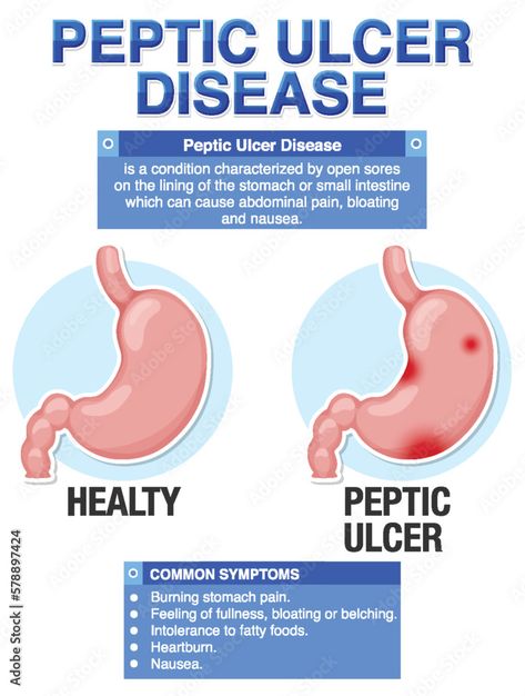 Infographic Design Layout, Chest Congestion, Stomach Ulcers, Health Life, Stomach Pain, Abdominal Pain, Acid Reflux, Health Facts, Design Layout