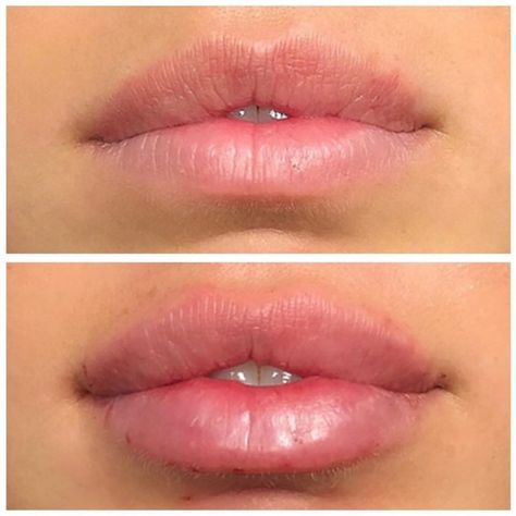 Keyhole Pout Lip Filler, Keyhole Lip Fillers, Keyhole Lips, Lip Goals, Lips Shape, Lips Inspiration, Botox Lips, Facial Anatomy, Visual Library