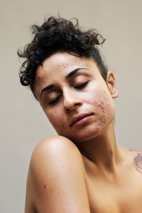 the #freethepimple movement wants you to embrace the skin you're in - i-D Body Positivity Photography, Acne Positivity, Skin Positivity, Human Photography, Real Skin, Real Bodies, Body Photography, Face Reference, Beauty Standards