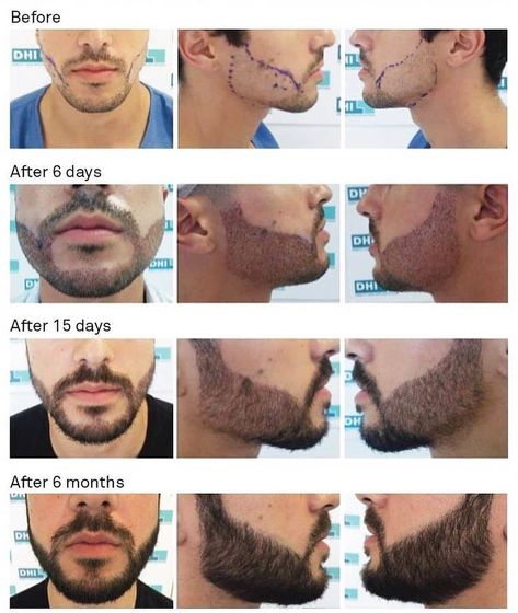 Beard Line, Beard Transplant, Hair Transplant Cost, Hair Transplant Procedure, South Point, Perfect Beard, Best Hair Transplant, Aesthetic Clinic, Full Beard