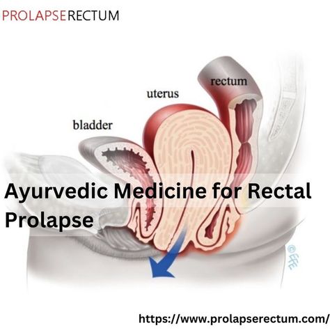 Rectal prolapse happens when your rectum, a portion of your large intestine, slips down inside your anus. Rectal Prolapse, Large Intestine, Ayurvedic Medicine, Muscles, Medicine, Health