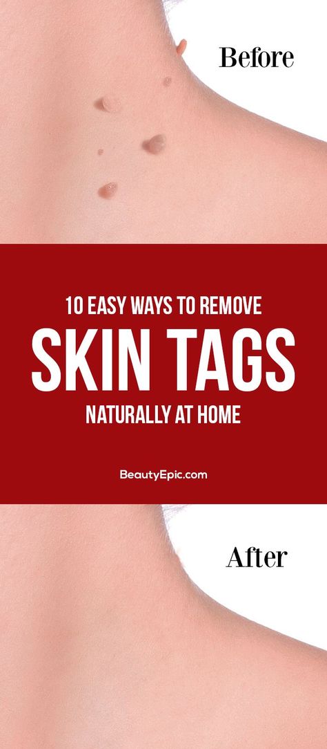 Home Remedies for Skin Tag Removal: To help one to remove these tags naturally, we have the most feasible ways to remove these tags at home Warts On Hands, Remove Skin Tags, Warts On Face, How To Remove Warts, Remove Skin Tags Naturally, Remove Warts, Home Remedies For Skin, Get Rid Of Warts, Skin Natural Remedies