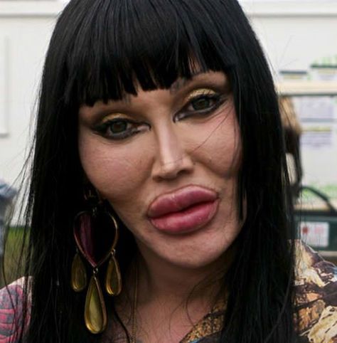 Plastic Surgery Pictures, Botched Plastic Surgery, Bad Plastic Surgeries, Plastic Surgery Fail, Scary People, Botox Before And After, Pete Burns, Plastic Surgery Gone Wrong, Makeup Fails