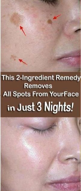 How to Get Rid of Dark Spots at Home Naturally Black Spots On Face, Bleaching Your Skin, Brown Age Spots, Brown Spots On Skin, Spots On Legs, Dark Spots On Face, Brown Spots Removal, Brown Spots On Face, Skin Spots