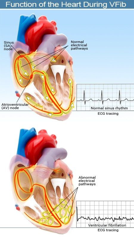 Afib Atrial Fibrillation, Normal Sinus Rhythm, Heart Rhythm, Normal Heart, Nuclear Medicine, Cardiac Nursing, Medical Emergency, Atrial Fibrillation, Heart Rhythms