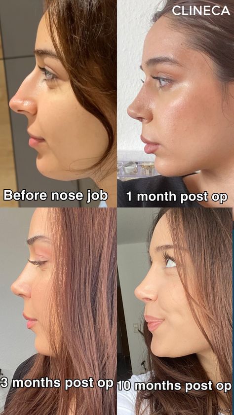 👃 1 Month: Swelling starts to go down, and the new shape is becoming more defined, but patience is key! You’ll notice changes daily.  💫 3 Months: Significant progress! Most of the swelling has subsided, and you’ll start seeing the final shape of your nose. Time to enjoy the results! 🌟  🌿 6 Months: Full healing and refinement of your nose's appearance. Your new look is here to stay! 🙌  Trust the process & enjoy your transformation! 💖 #NoseJob #Rhinoplasty #BeforeandAfter Side Profile Before And After, Rhinoplasty Results, Nose Job Results, Best Nose Shape, Turkey Nose Job, Subtle Nose Job, Ideal Nose Rhinoplasty, Nosejob Rhinoplasty Before After, Lower Blephoraplasty Before And After