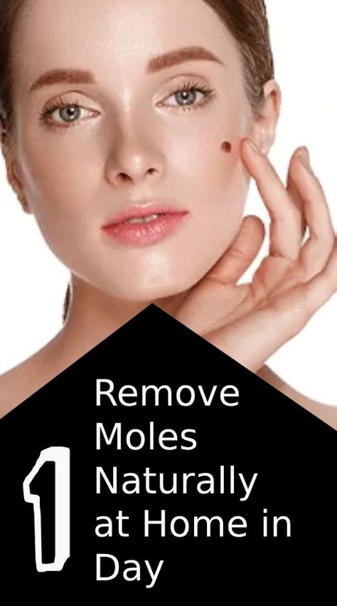 Easy Way to Remove Moles Naturally at Home in One Day Remove Moles Naturally, Natural Mole Removal, Instant Migraine Relief, Facial Mole, Moles On Face, Remove Moles, Remove Skin Tags Naturally, Fresh Aloe Vera Gel, Nose Picking