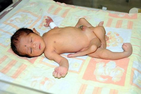 A six legged baby boy born in Sukkur area of Pakistan is being treated at National Institute of Child Health in Karachi (615×409) Circus Freaks, Twin Pictures, Human Oddities, Conjoined Twins, Nuclear Energy, Baby Legs, Fukushima, Chernobyl, Gone Wrong