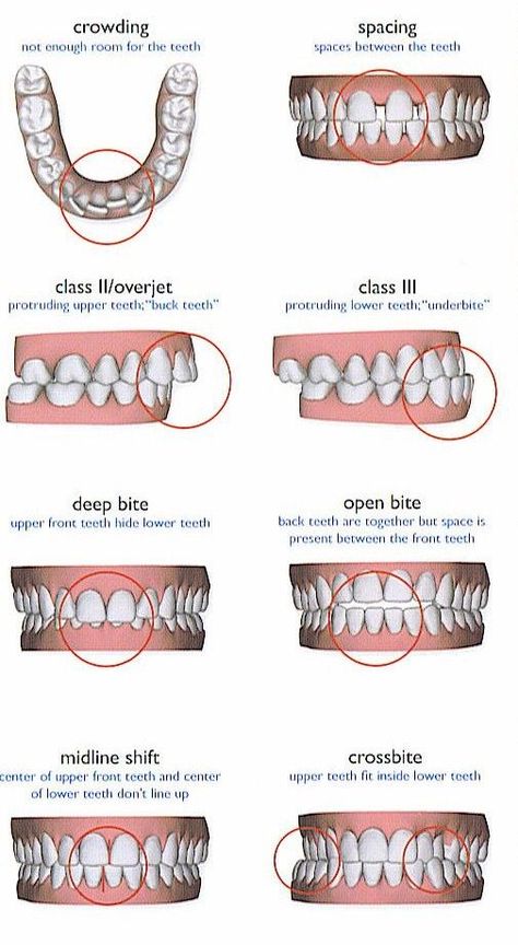 Natural Teeth Whitening, Toddler Tooth Decay, Remedies For Tooth Ache, Tooth Decay Remedies, Loose Tooth, Receding Gums, Stained Teeth, Preventative Health, Dental Supplies