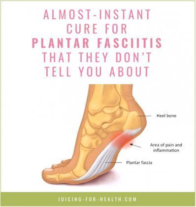 Facitis Plantar, Foot Pain Relief Remedies, K Tape, Heel Pain Relief, Pain Relief Remedies, Foot Pain Relief, Back Pain Remedies, Foot Health, Natural Health Remedies