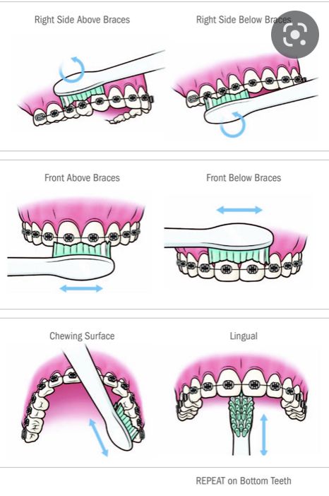 Dental Braces Colors, Braces Food, Cute Braces Colors, Braces Tips, Getting Braces, Haut Routine, Cute Braces, Kedokteran Gigi, Brace Face