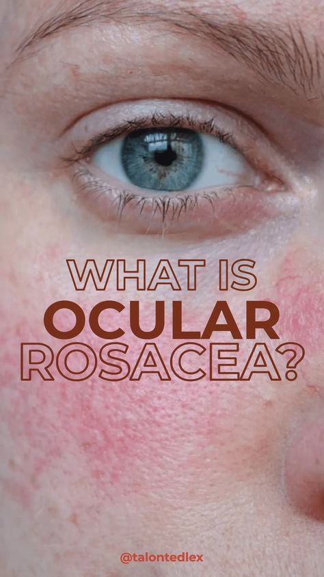 Diagnosed with ocular rosacea? Absolutely no idea what to do next? This blog post will help. Ocular rosacea tips and rosacea advice #talontedlex Skin Care 30s Women, Serious Questions, Saving Face, Eye Problems, Moisturizer For Sensitive Skin, Acne Treatments, Anti Redness, Teeth Health, Anti Aging Eye Cream