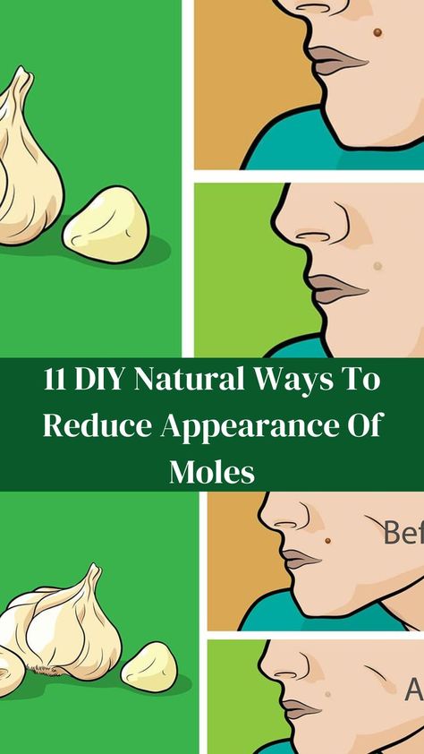 11 DIY Natural Ways To Reduce Appearance Of Moles Moles On Face, Remove Moles, Remove Skin Tags Naturally, Top 10 Home Remedies, Crush A, Onion Juice, Skin Growths, Mole Removal, Grapefruit Seed Extract