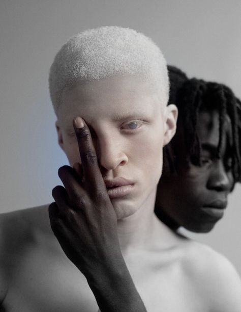 ORIGINS<---- albino-ism Albino Model, Matthew Stone, Shaun Ross, Skin Grafting, We Are The World, Interesting Faces, White Hair, Black Is Beautiful, Black People