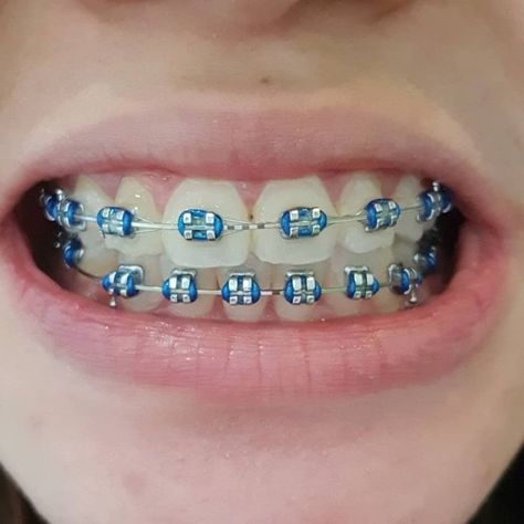 Dental Braces Colors, Braces Colors Combinations, Invisible Teeth Braces, Braces Bands, Cute Braces Colors, Braces Cost, Kids Braces, Adult Braces, Braces Tips