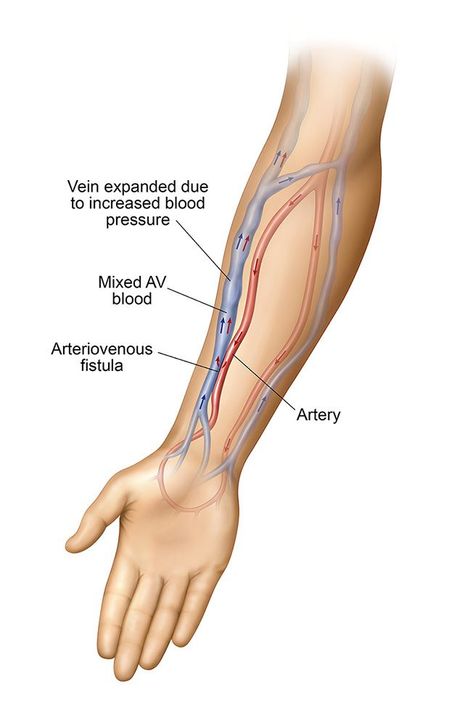 What Causes Stenosis in an AV Fistula and How Do I Recognize It? Medical Terminology Study, Vascular Ultrasound, Blood Sugar Solution, Vascular Surgery, Summer Health, Arteries And Veins, Medical School Essentials, Medical Anatomy, Clinic Design