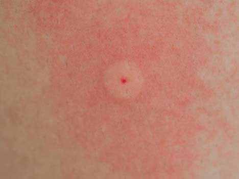 10 Common Bug Bites | Identification And More - The Premier Daily : The Premier Daily Types Of Bug Bites, Spider Bites Pictures, Fire Ant Bites, Wasp Sting, Deer Fly, Ant Bites, Wasp Stings, Types Of Spiders, Red Ant