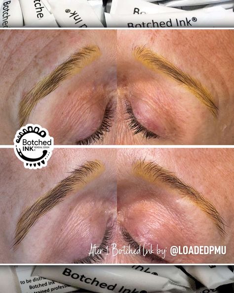 Yellow brows after laser: Save this post and join our Botched Ink removal case study 😊 The story so far… A lengthy difficult one 🫤 Multiple laser tattoo removals, plus multiple chemical (not saline) removals. Then the client found Botched Ink 😍 Botched Ink is a max potency saline solution, with a gentle method, easy healing and consistent results We can get into those pigment levels, stirring up any scar tissue, flushing up and out that old yellow pigment 🟡 You can already see it look... Ink Removal, The Story So Far, Saline Solution, Laser Tattoo, Laser Tattoo Removal, Scar Tissue, Tattoo Removal, The Client, Case Study